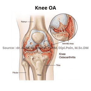 Osteoarthritis
